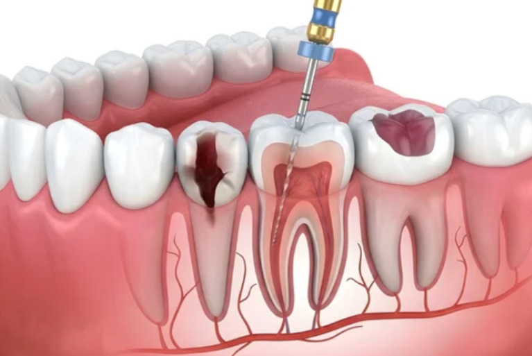 根管治療とは？