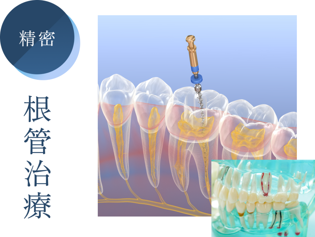 根管治療